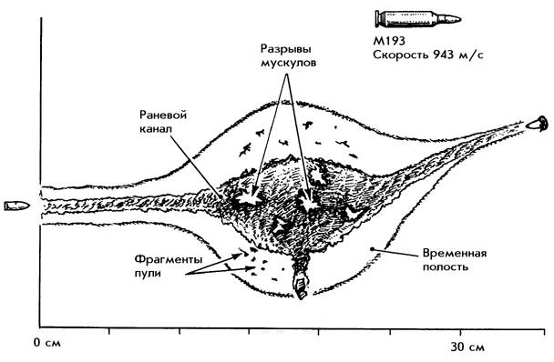 раневой канал